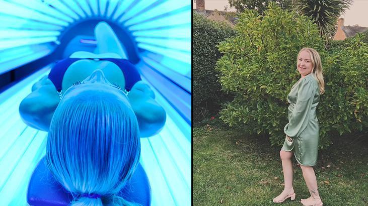 Bronzlaşmak isterken kanser oldu! Solaryum hayatını kararttı